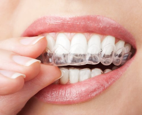 Express Wevering® ג'ל הלבנת שיניים מקצועי - שנקבע על ידי רופאי שיניים - שעה ללבוש. ראה תוצאות בימים.