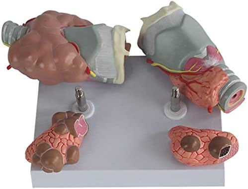 מודל ההוראה של RRGJ, מודל פתולוגיית בלוטת התריס מוגדל של בלוטת התריס האנושית מודל אנטומיה חולה מודל אנטומיה