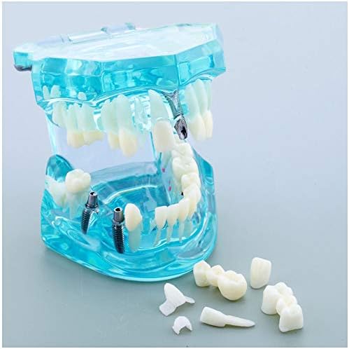 מודל שיניים פתולוגיות של KH66Zky - דגם שיניים של שתל שיניים שקוף - עבור רופא שיניים סטנדרטי סטנדרטי נשלף כלי לימוד