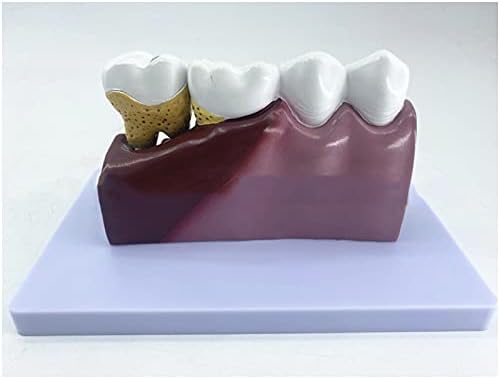 Kh66zky דגם אנטומי טוחני תחתון - מודל פתולוגיה שיניים - עם עששת, עצב שיניים, מפורט מאוד, הגדלה 6 x